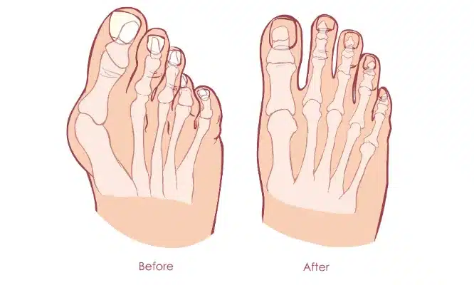 Bunion Before and After