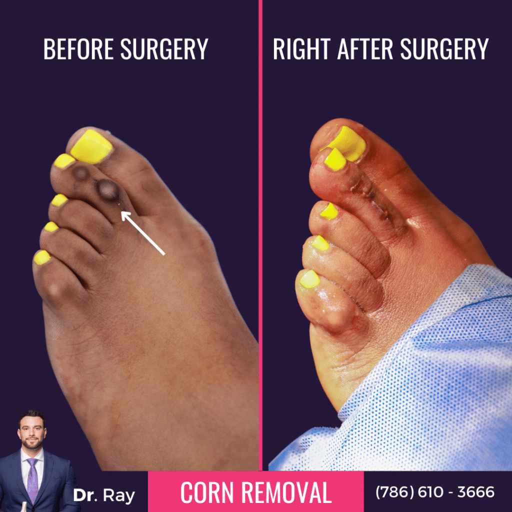 Corn Removal Surgery Before And After