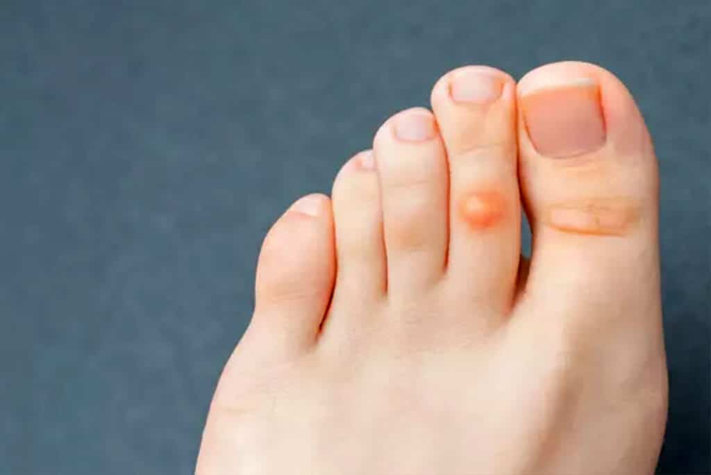 corn on 2nd digit toe