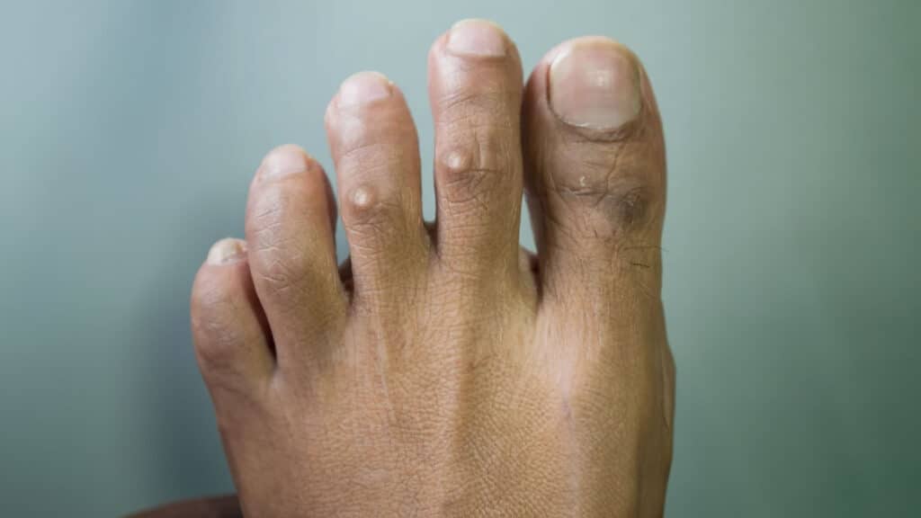 What is the Essential Difference Between a Corn and a Bunion? Unveiling