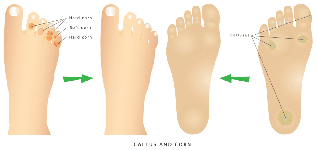 corn surgery recovery