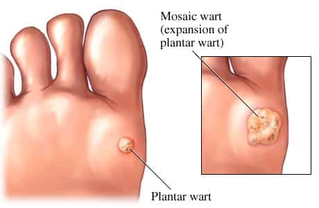 corns removal recovery