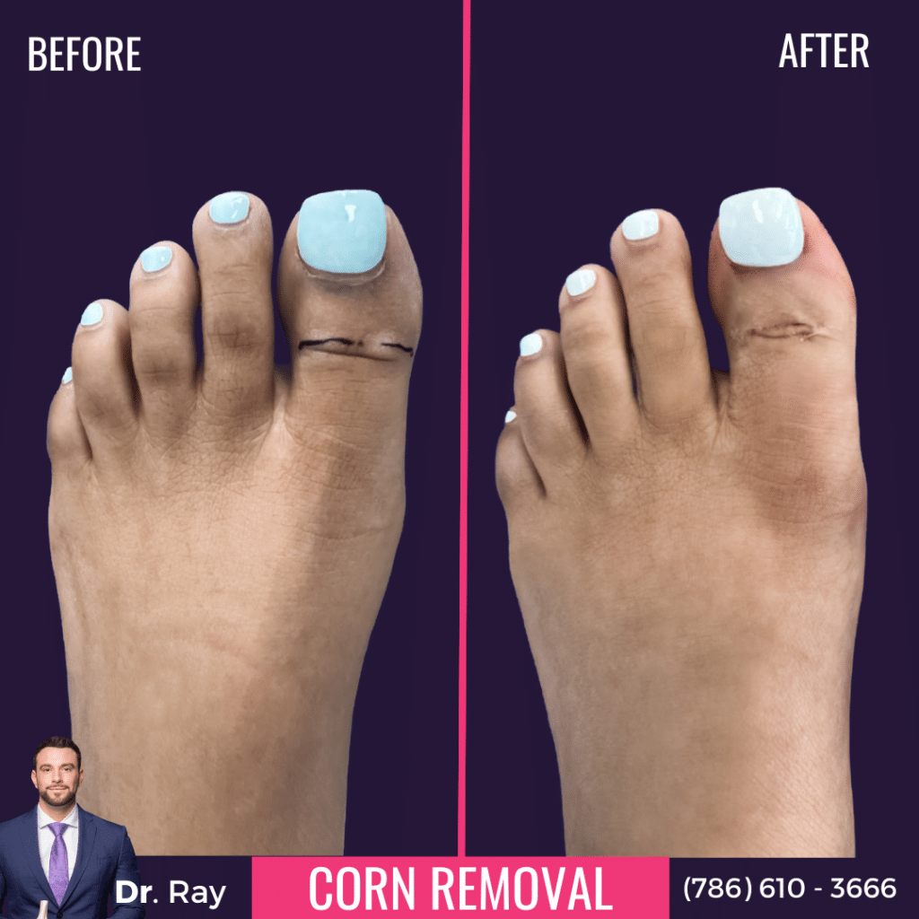 Corn Removal Surgery Before And After